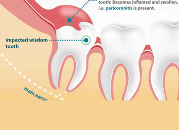 Dental Implants in Ahmedabad